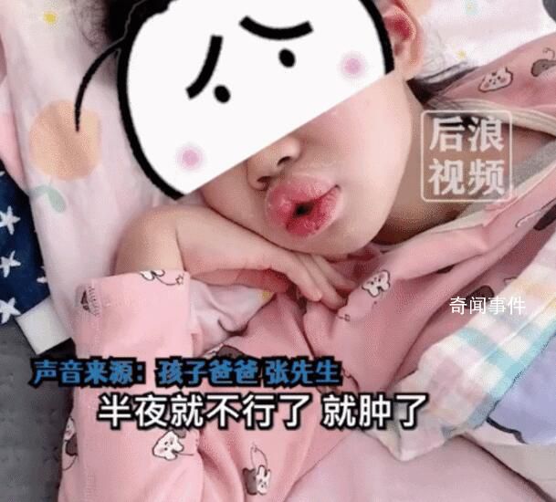 8歲女孩吃布洛芬過敏腫成香腸嘴 目前孩子無礙
