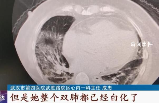 白肺是否會對肺部造成不可逆傷害 這些人做個CT很有必要
