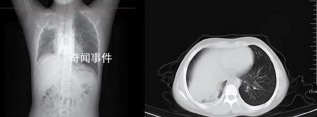 男孩咳嗽發熱在家硬扛成白肺 目前的癥狀已經明顯好轉