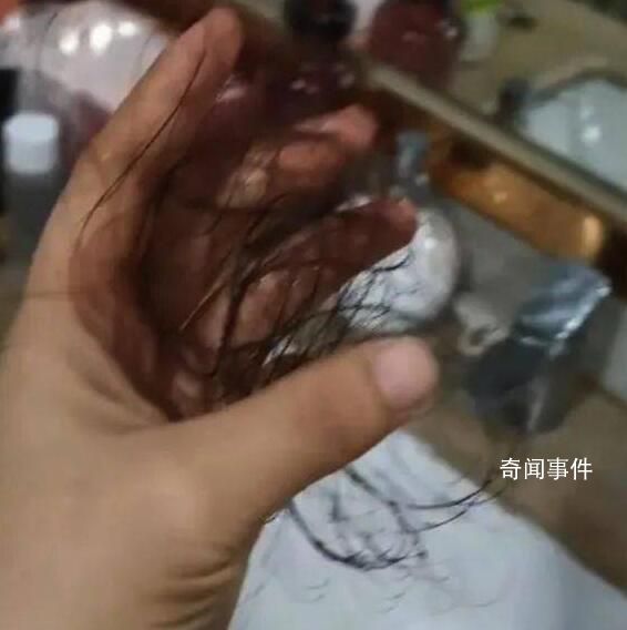 女子發燒躺10多天頭發變成離子燙 10多天沒有梳洗