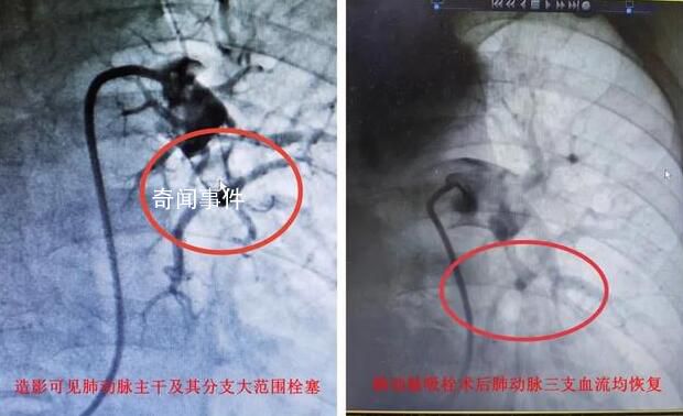陽性一個月后肺栓塞風險增加33倍 一醫生接連搶救兩名患者都出現了胸悶胸痛癥狀
