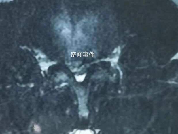 男子長期久坐后被診斷截癱 醫生緊急提醒