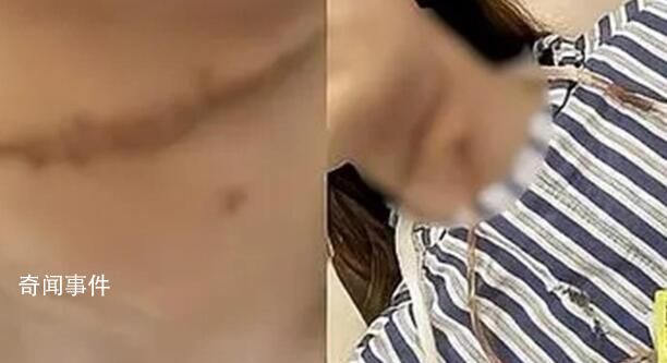 被丈夫割喉女子獲發人身安全保護令 婦聯：已介入事件
