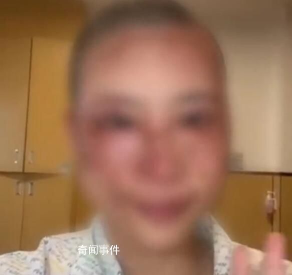 女子遭家暴被潑硫酸丈夫僅行拘10天 面部毀容身心飽受折磨