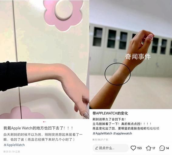 多人稱戴蘋果手表“手凹了” 摘下來幾個小時了坑還在