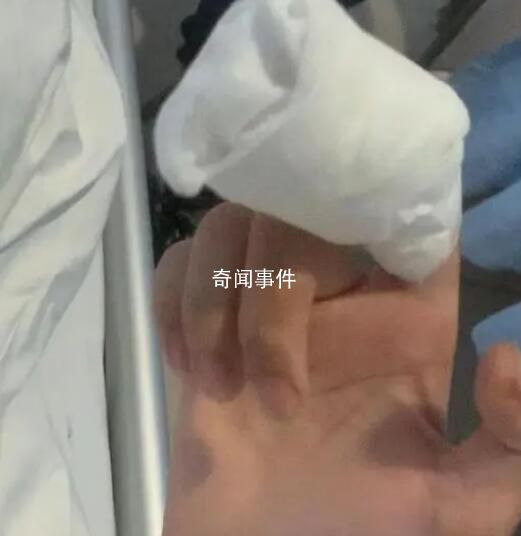 男孩啃禿10個指甲引發骨髓炎 目前孩子已轉危為安