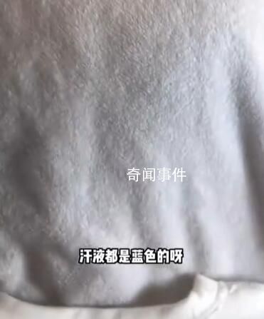 女孩出汗把衣服染藍(lán)查出色汗癥 色汗癥是怎么引起的