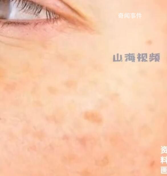 25歲女生長(zhǎng)期熬夜長(zhǎng)出老年斑 網(wǎng)友看后都心有戚戚焉