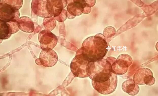 致命真菌在美國蔓延 近一半感染者90天內死亡
