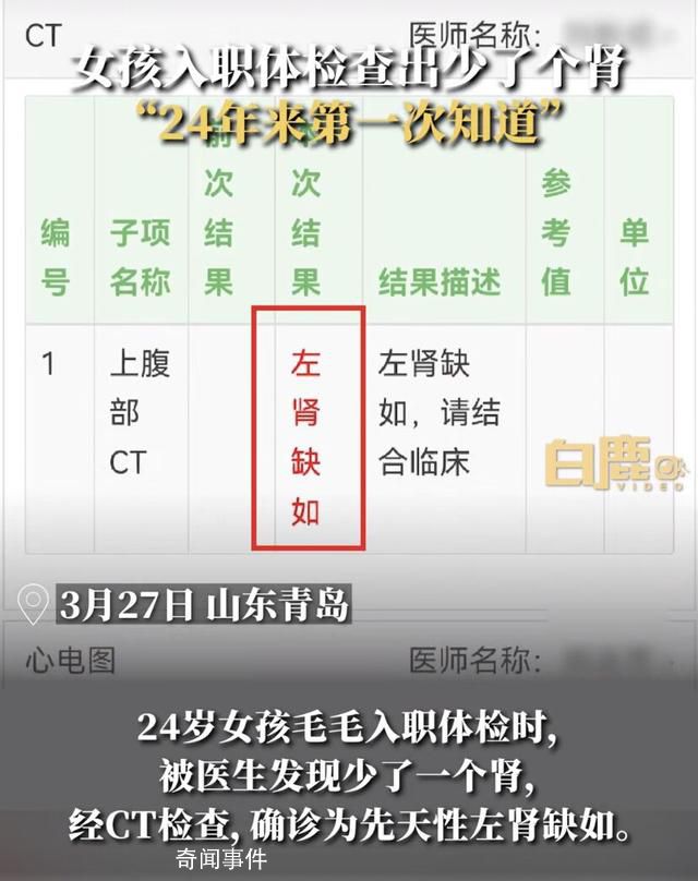 24歲女孩入職體檢查出少一個腎 確診為先天性左腎缺如