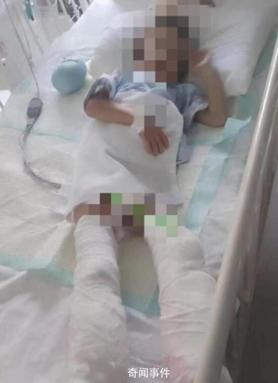 被生母虐待致截肢男童父親再發(fā)聲 希望能保住眼睛