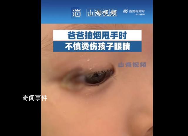 爸爸甩煙不慎致孩子眼角燙傷 引發網友熱議