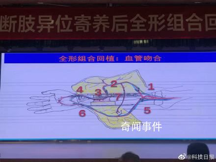 男子斷臂后寄養(yǎng)小腿1月成功回植 該手術(shù)屬世界首例
