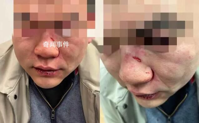 中國男子在倫敦遇襲 被打至眼眶骨折