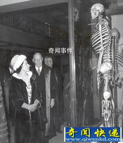 揭秘巨人家族未解之謎 基因突變導(dǎo)致出現(xiàn)巨人癥