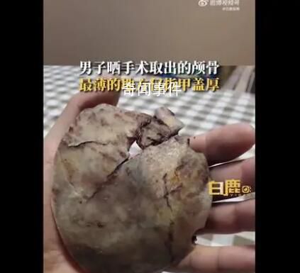 男子術后曬顱骨碎片:最薄處像指甲
