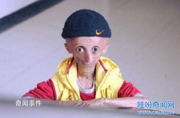 揭秘未老先衰男童未解之謎 未老先衰是一種怎樣的狀態