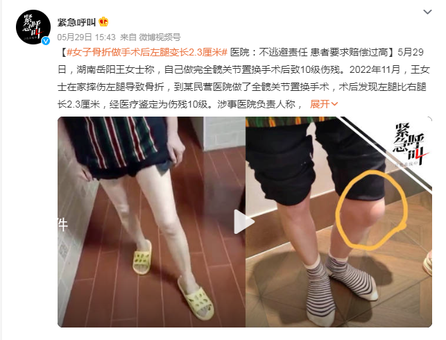 女子骨折做手術后左腿變長2.3厘米 經醫療鑒定為傷殘10級