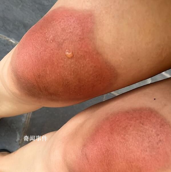 穿破洞褲致大腿曬傷 來云南穿好長袖長褲做好防曬
