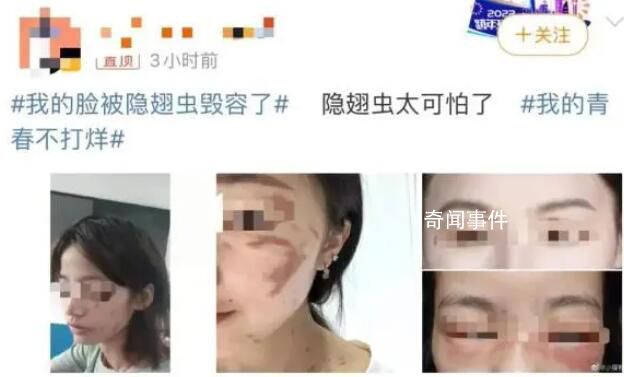 隱翅蟲(chóng)的毒液堪比硫酸 隱翅蟲(chóng)咬后皮膚潰爛幾天能夠好