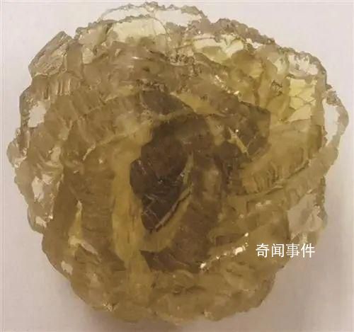臺州女子身體里取出了“花” 長得像玫瑰一樣的結石你見過嗎?