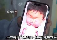 3歲男孩患象鼻病全球僅34例 象鼻病是什么病
