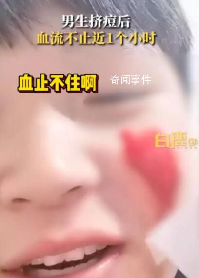 男生擠痘流血近1小時:用了400張紙