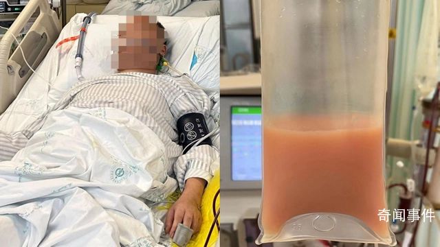 男子熬夜喝冰鎮飲料被送進ICU 突然出現了劇烈的腹痛