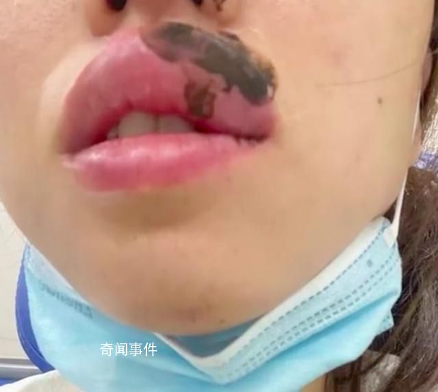 女子睡覺被蜈蚣咬醒 嘴腫成“香腸”