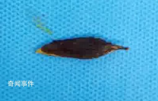 男子吃粽子誤吞棗核致小腸穿孔 醫院已收治不少誤吞棗核的患者