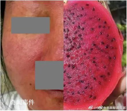 杭州女子養倉鼠臉爛成火龍果 全身布滿紅斑