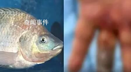 男子被魚刺刺傷致手指壞死被截除 引發(fā)了廣泛關注