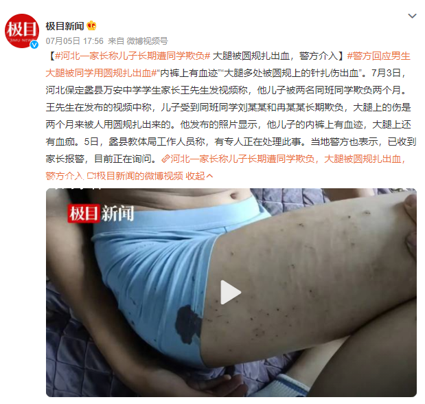男生遭同學(xué)欺負(fù)大腿被圓規(guī)扎出血 教體局工作人員稱有專人正在處理此事
