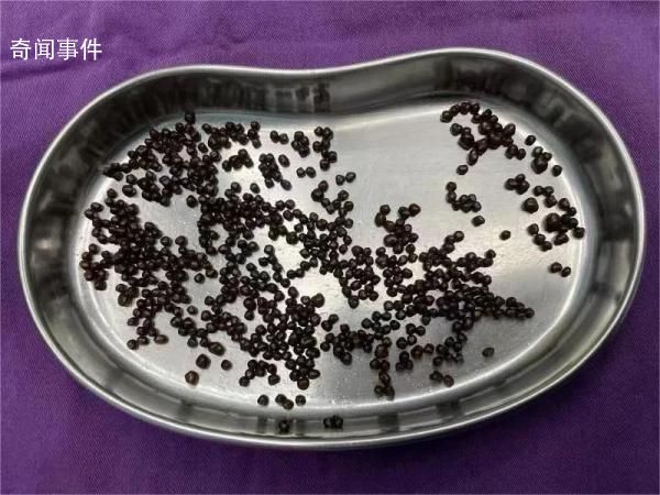 女子體內取出幾百顆結石如魚子醬 醫生：這種結石有癌變傾向