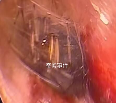 蜘蛛在男子睡夢時鉆入耳道結網 網友：看著就疼