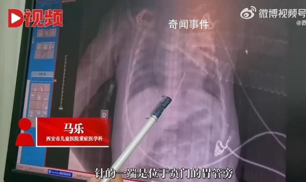 女嬰心臟扎進(jìn)一根4厘米繡花針 患兒目前在PICU進(jìn)行康復(fù)治療