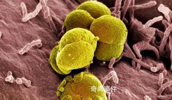 小伙使用酒店毛巾后被確診淋病 出現流淚尿痛癥狀