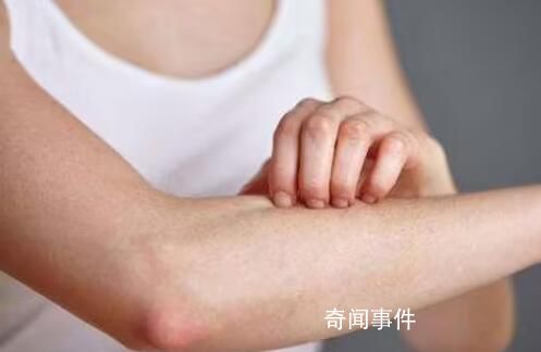 過敏多發(fā) “元兇”就在身邊 低齡患者明顯增多