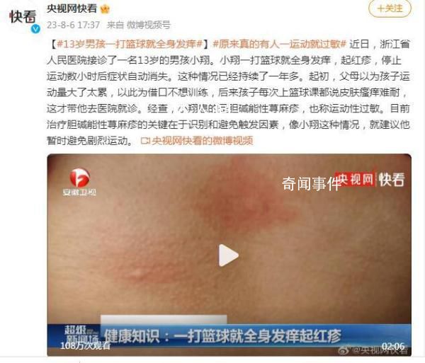 13歲男孩一打籃球就全身發癢 這種情況已經持續了一年多