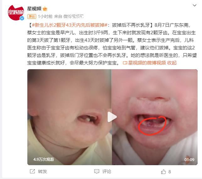 早產(chǎn)兒出生罕見長(zhǎng)2顆牙先后被拔掉 拔掉后不再長(zhǎng)乳牙