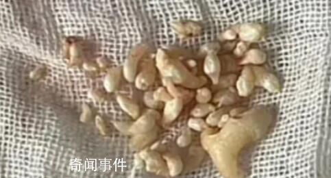 拔掉57顆牙是什么體驗 牙瘤是什么病嚴(yán)重嗎