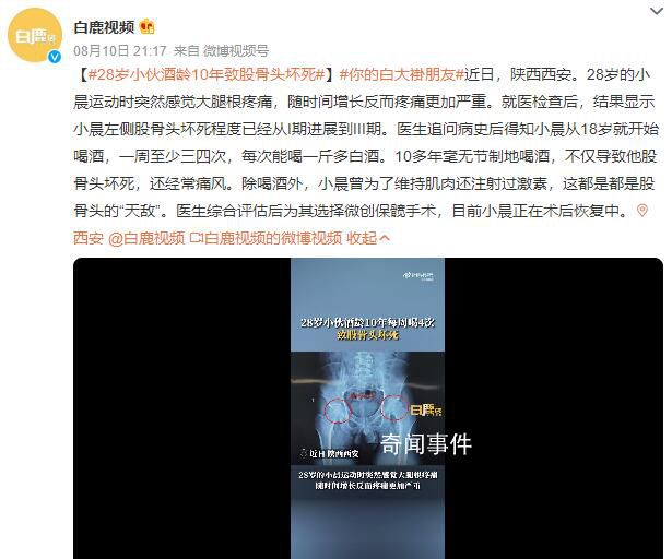 28歲小伙酒齡10年致股骨頭壞死 目前正在術后恢復中