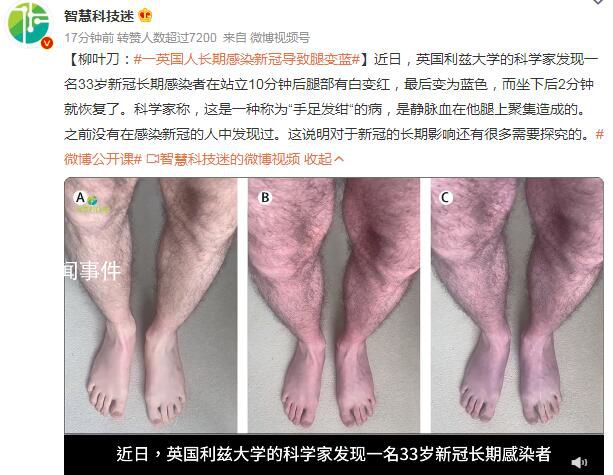 一英國人長期感染新冠導(dǎo)致腿變藍 坐下后2分鐘就恢復(fù)了