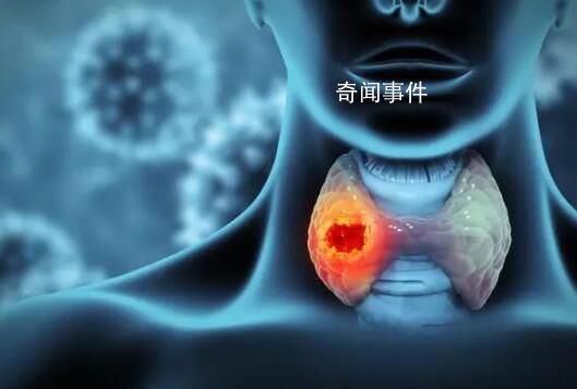 浙江12歲女孩確診甲狀腺癌 小小年紀為什么會扯上甲狀腺癌