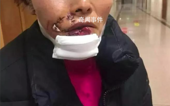 女子被狗撕碎左臉縫了500多針