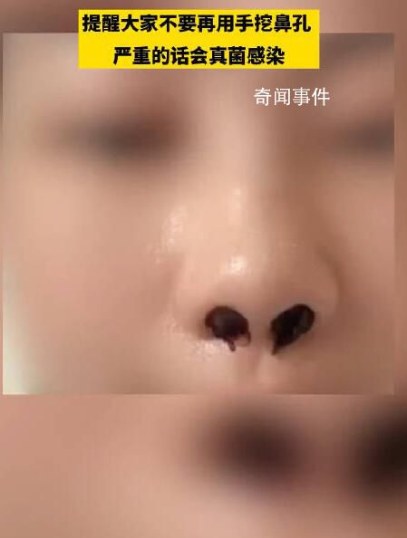 女生稱因愛摳鼻子致鼻內長多團真菌 ：希望大家不要再挖鼻孔