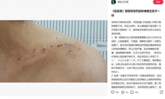 胡歌被曝拍偽裝者時砸斷女主鎖骨 因為要拍戲只能進行手術打了七顆鋼釘