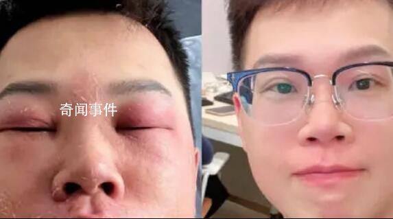 小伙稱因長(zhǎng)期摳鼻子感染丹毒 面部還有些紅印在做光療