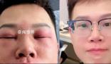 小伙稱因長期摳鼻子感染丹毒 面部還有些紅印在做光療