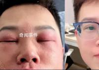 小伙稱因長期摳鼻子感染丹毒 面部還有些紅印在做光療